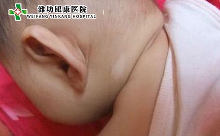 白癜风,儿童白癜风,白癜风症状