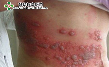 带状疱疹,带状疱疹多久好