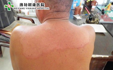 体癣,体癣症状,体癣症状图片