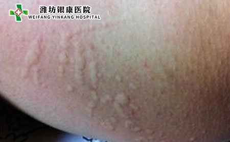 荨麻疹,荨麻疹症状图片,荨麻疹表现